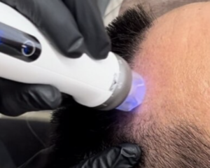 最新】美容液導入器ノアグロウ｜育毛・美肌・痩身対応の最新美容機器を