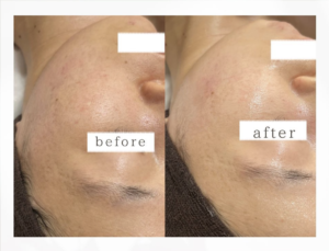 美容液導入器ACトリートメントの効果や口コミは？特徴や導入費用をご