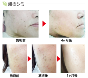 低周波ペンシルとは？シミ取り効果や失敗しないための選び方は