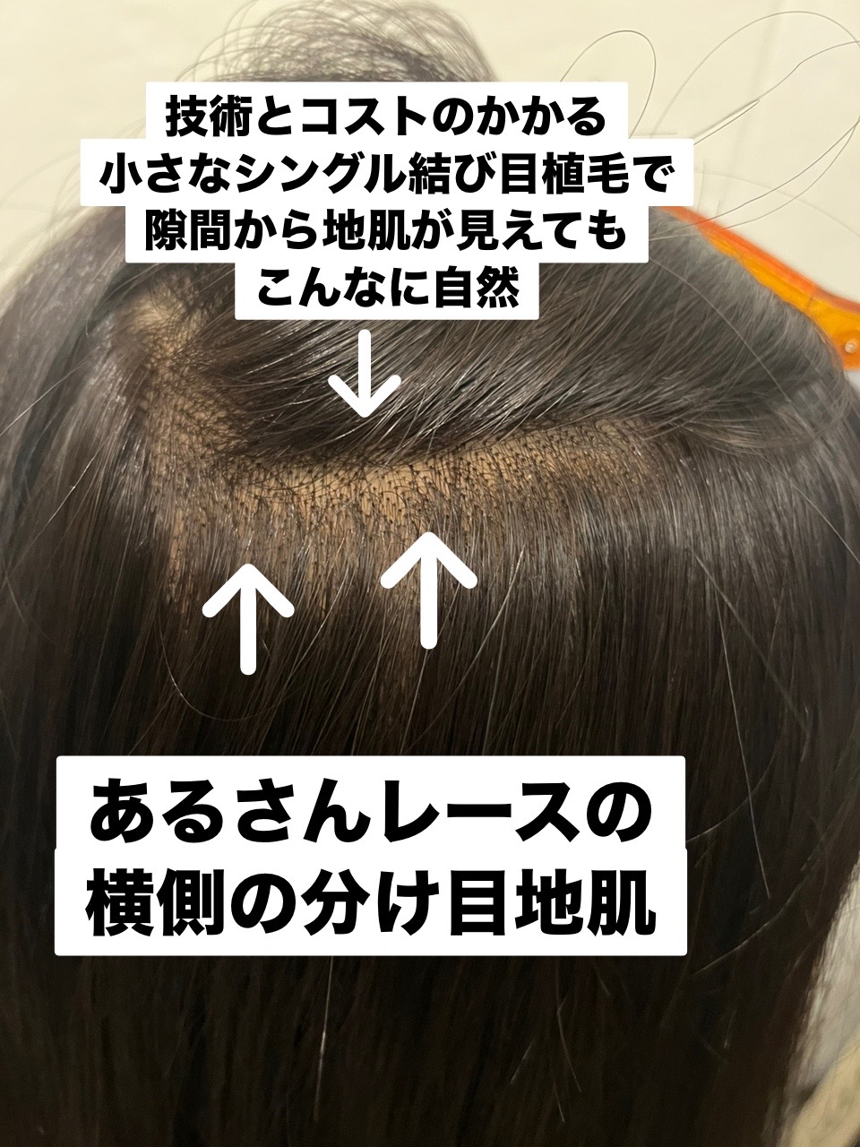 いやしのウィッグ evergreen / あるさんウィッグ®レース総手植え