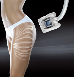 エンダモロジー セルM6アライアンス（本体） | 業務用美容・エステ機器