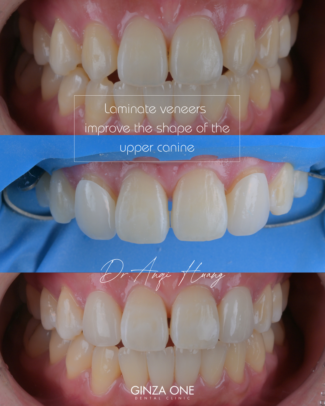 ラミネートベニア ≠「歯を小さく削る治療」｜銀座ONE歯科・矯正歯科
