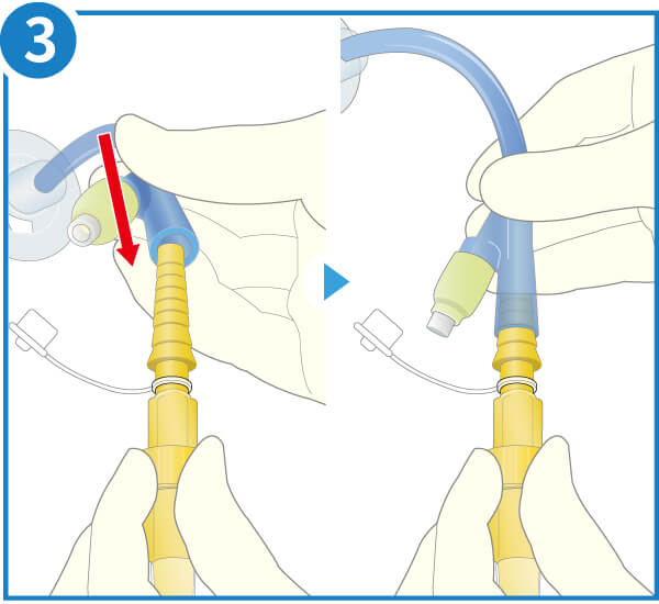 在庫限り】ニプロ EN加圧バッグCS（加圧ポンプ専用）｜ 医療用品通販