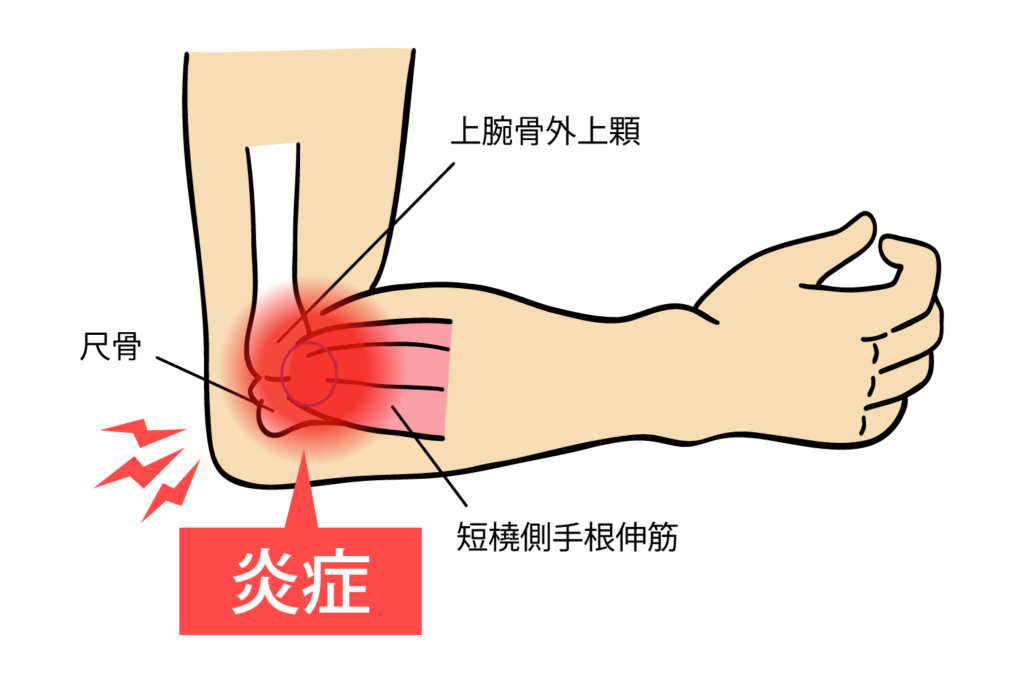 一宮市でテニス肘（上腕骨外側上顆炎）の改善なら｜はないけ接骨治療院