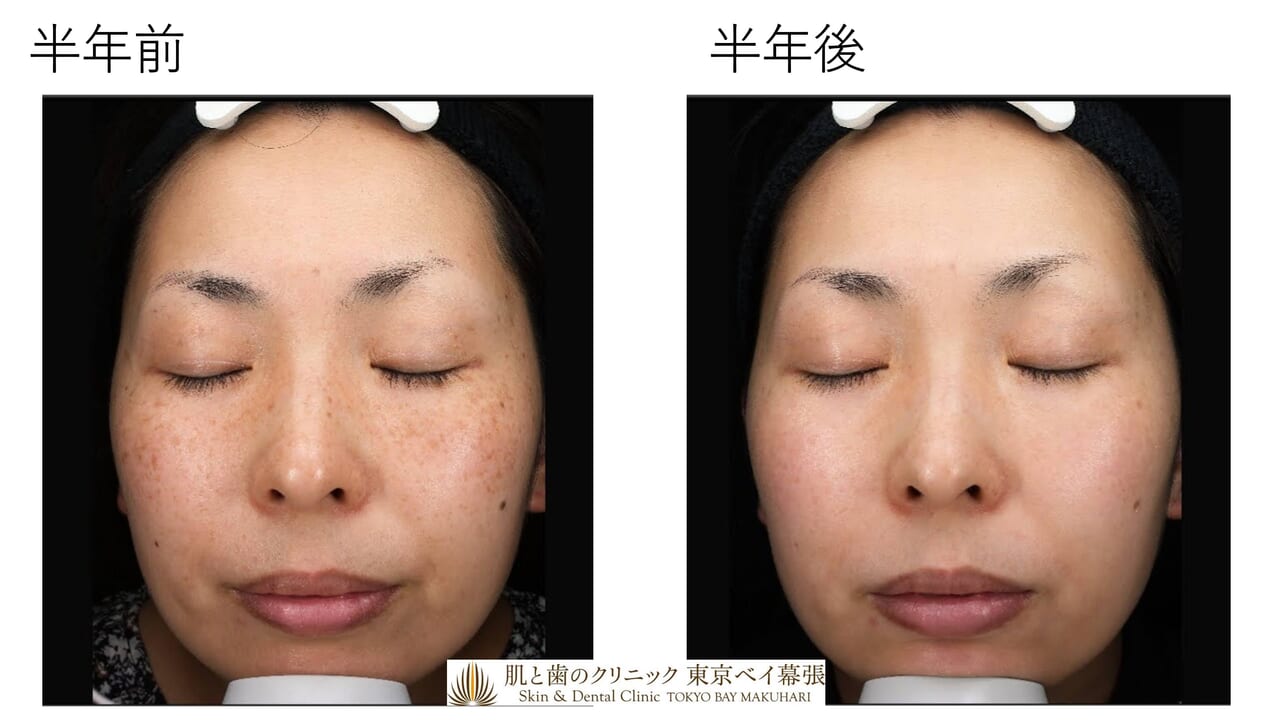 モニター募集 | しみほくろ半年コース | 肌と歯のクリニック 東京ベイ