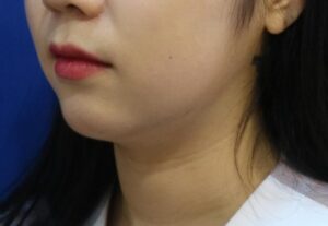 脂肪溶解注射『Fat X Core（ファットエックス コア）』を新規導入