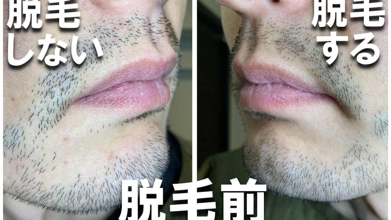 暴露【顔半分だけ1年髭脱毛】動画と写真全て見せる！人気家庭用脱毛器