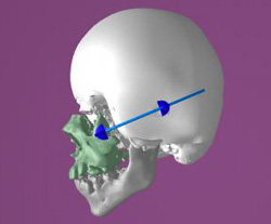 形成外科｜頭蓋骨縫合早期癒合症（狭頭症）治療・手術｜順天堂大学