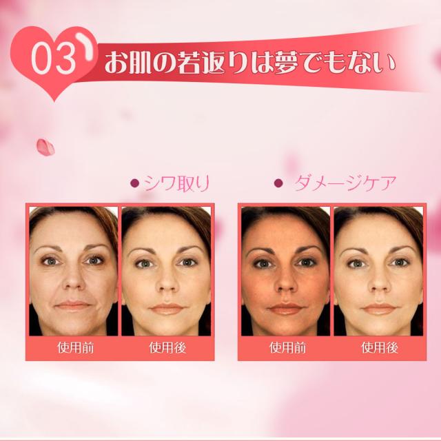 マイクロニードル 540針 美顔ローラー 顔 美顔器 0.25mm 0.5mm 1mm 2mm