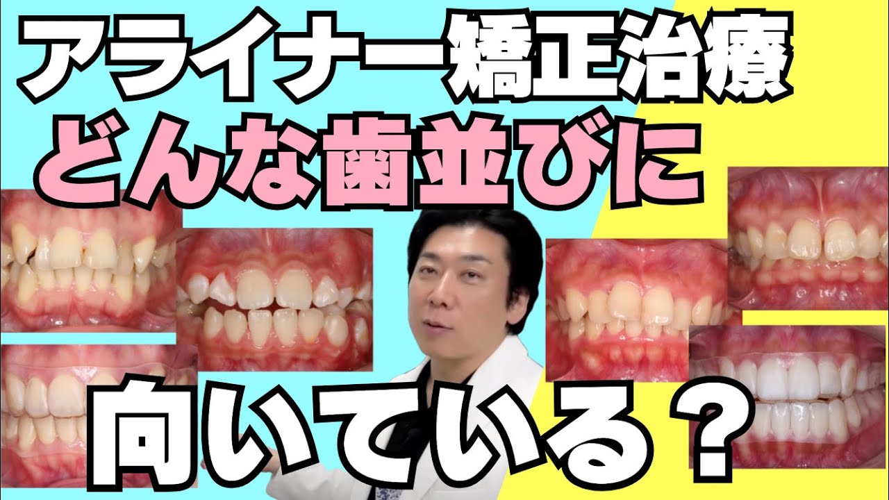 アライナー矯正治療はどのような症例に適している？解説します - YouTube