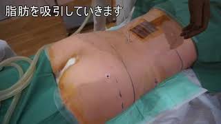 脂肪吸引の魅力と怖いところが分る！術前得るべき12の知識