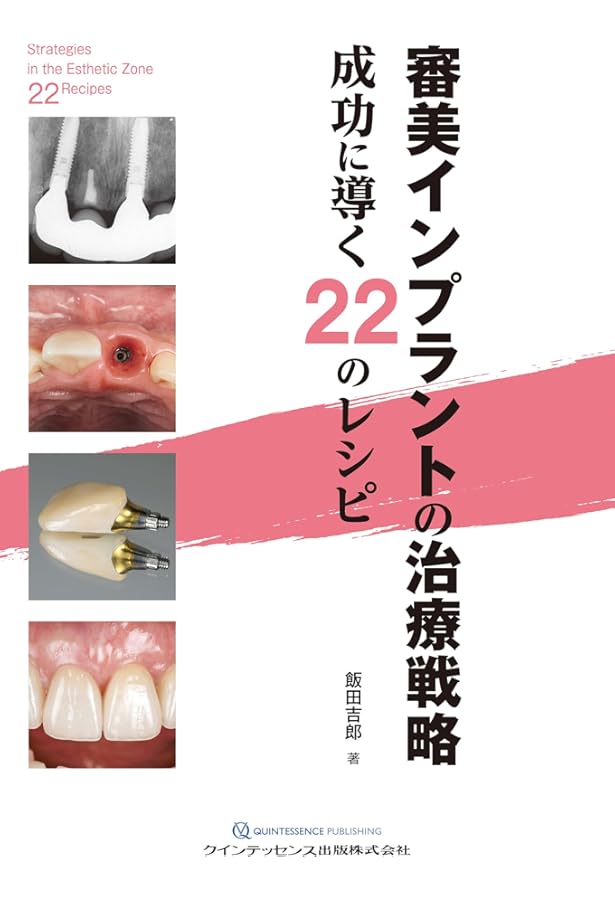 シングル・トゥースインプラント: 前歯部および臼歯部抜歯窩に対する低