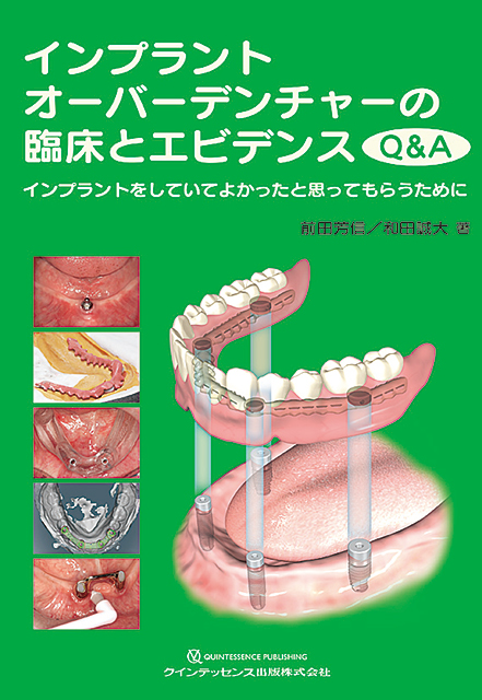 ITI Treatment Guide Volume 8 インプラント治療における合併症