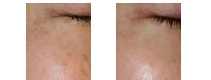 エレクトロポレーション（導入しました） | 小西皮ふ科