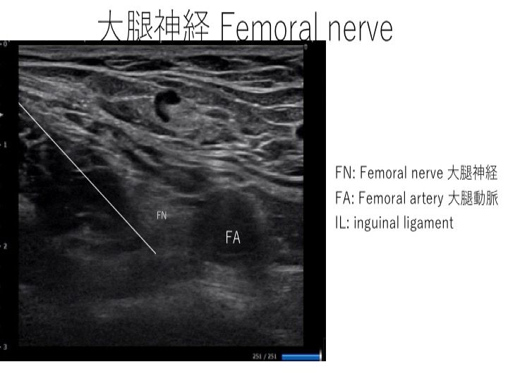 超音波ガイド下神経ブロックによる疼痛マネージメント : スポーツ整形