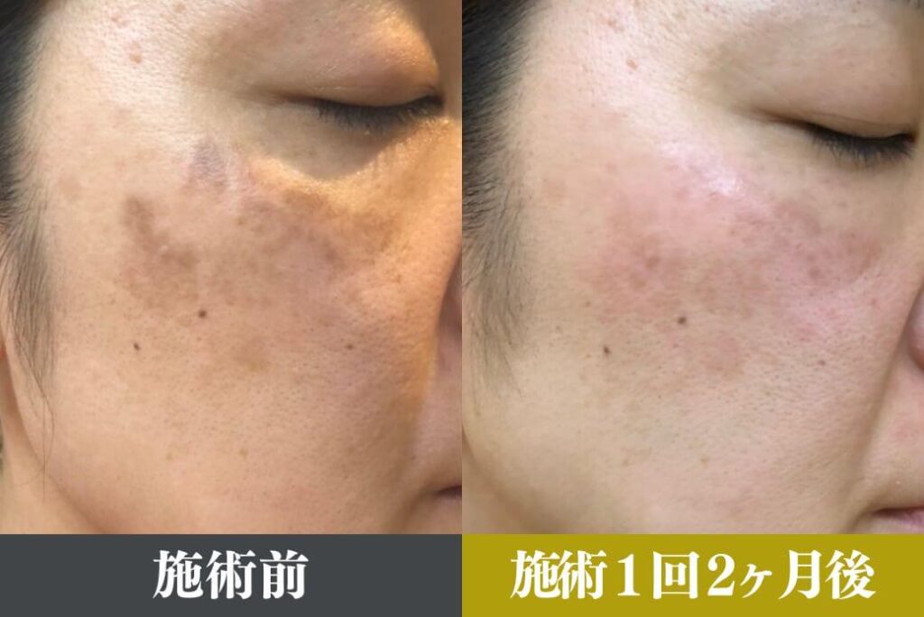 シミを薄くする方法】自宅でできる簡単ケアと美容皮膚科の治療をご紹介