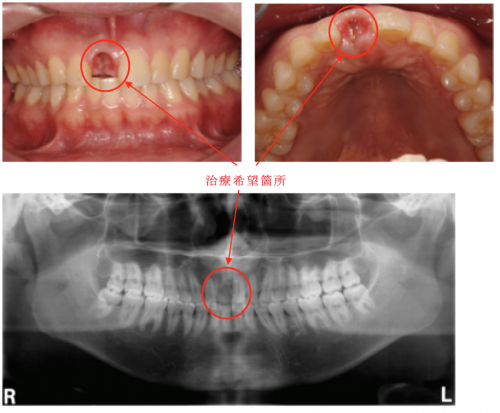 咬合性外傷（前歯の破折）の治療〜インプラントの症例 【詳細