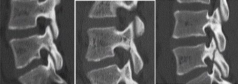 腰椎分離症 | 間庭整形外科