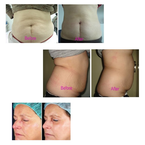 キャビエスト キャビテーション ラジオ波/RF機器の通販｜美セラ