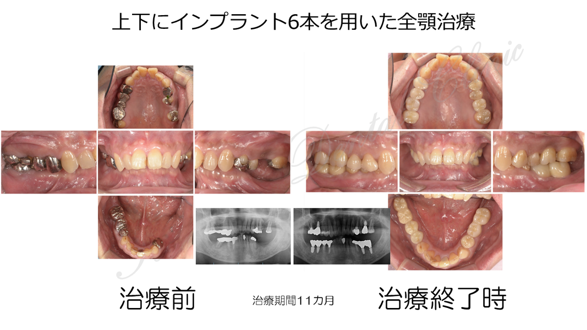 上下6本インプラントの全顎治療症例 | 箕面市の歯医者【寺嶋歯科医院