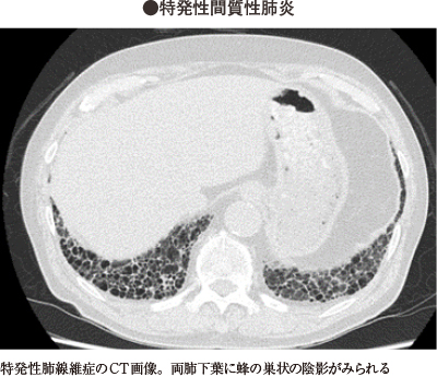間質性肺炎〔かんしつせいはいえん〕｜家庭の医学｜時事メディカル