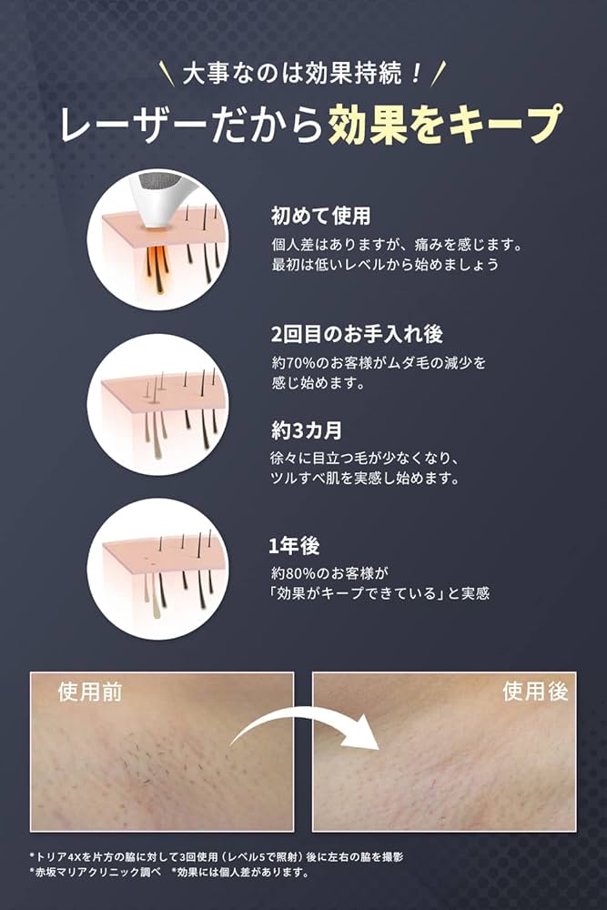 Amazon.co.jp: Tria Personal Laser Epilator Precision Laser Hair