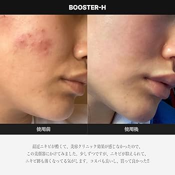 Amazon.co.jp: メディキューブ AGE-Rスキンブースターショット 【1日5