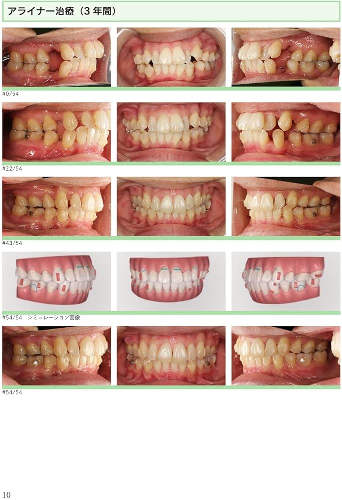 Amazon.co.jp: アライナー矯正のリカバリーテクニック : 槇 宏太郎, 槇