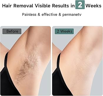 Amazon.com: JOVS Laser Hair Removal, 37°F Painless Hair Removal