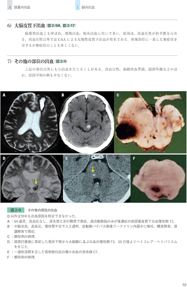 同一症例の経過・画像・病理で紐解く 臨床神経病理ワールド | 宇高不可