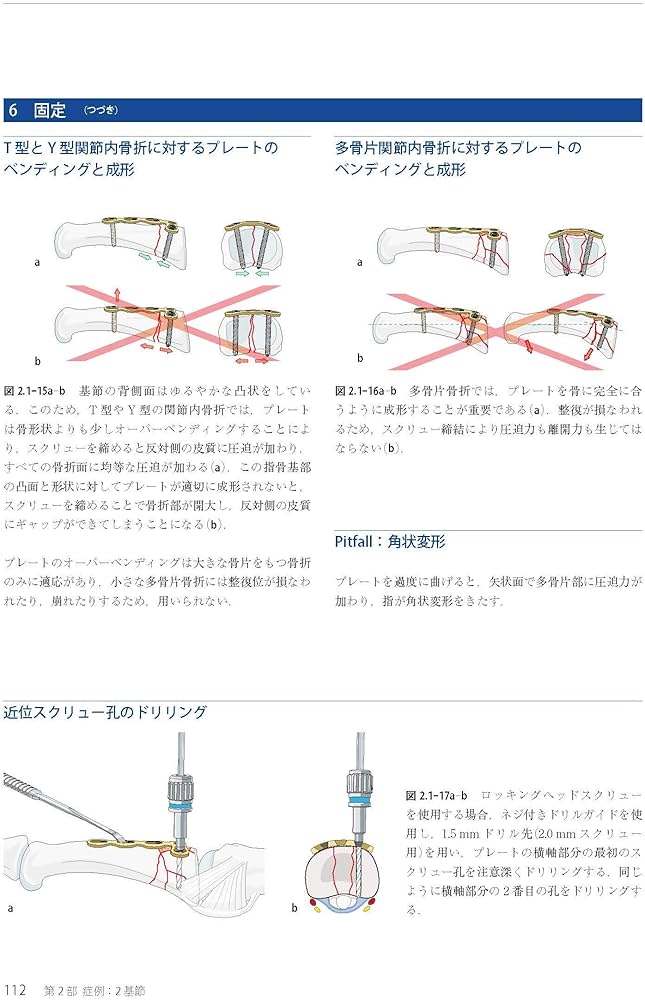 Amazon.co.jp: AO法骨折治療 Hand (AOTRAUMA) : 田中 正: 本