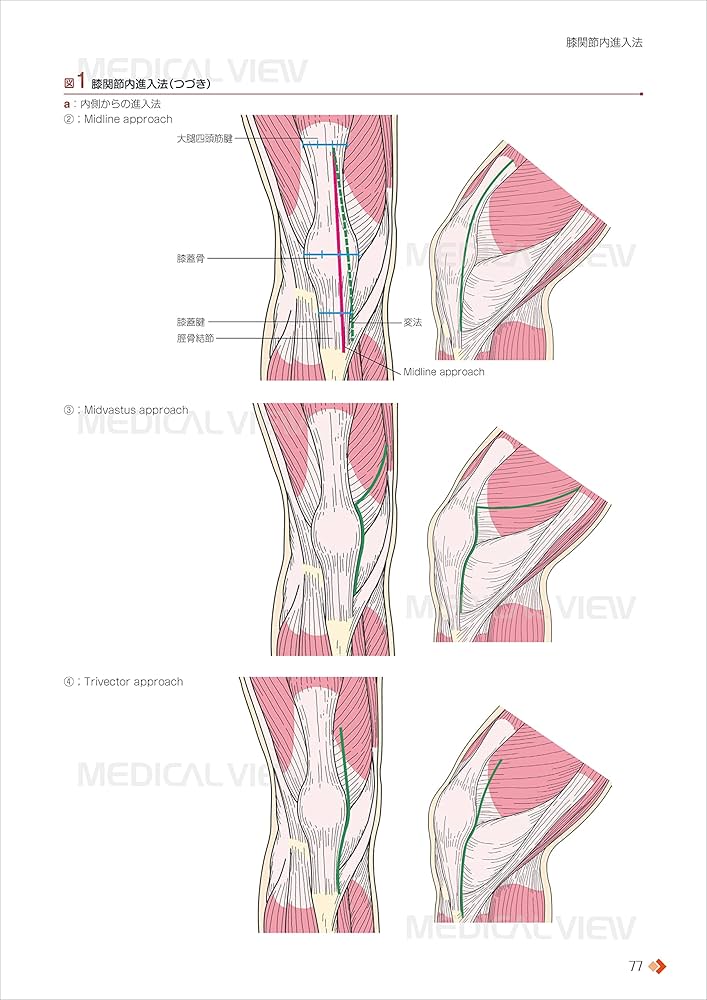 人工膝関節全置換術[TKA]のすべて−より安全に・より確実に | 勝呂 徹