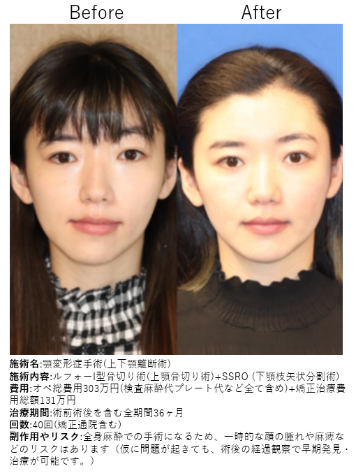 顎変形症は手術が必要？ 顔の変化と医療機関の選び方を解説【歯科医師