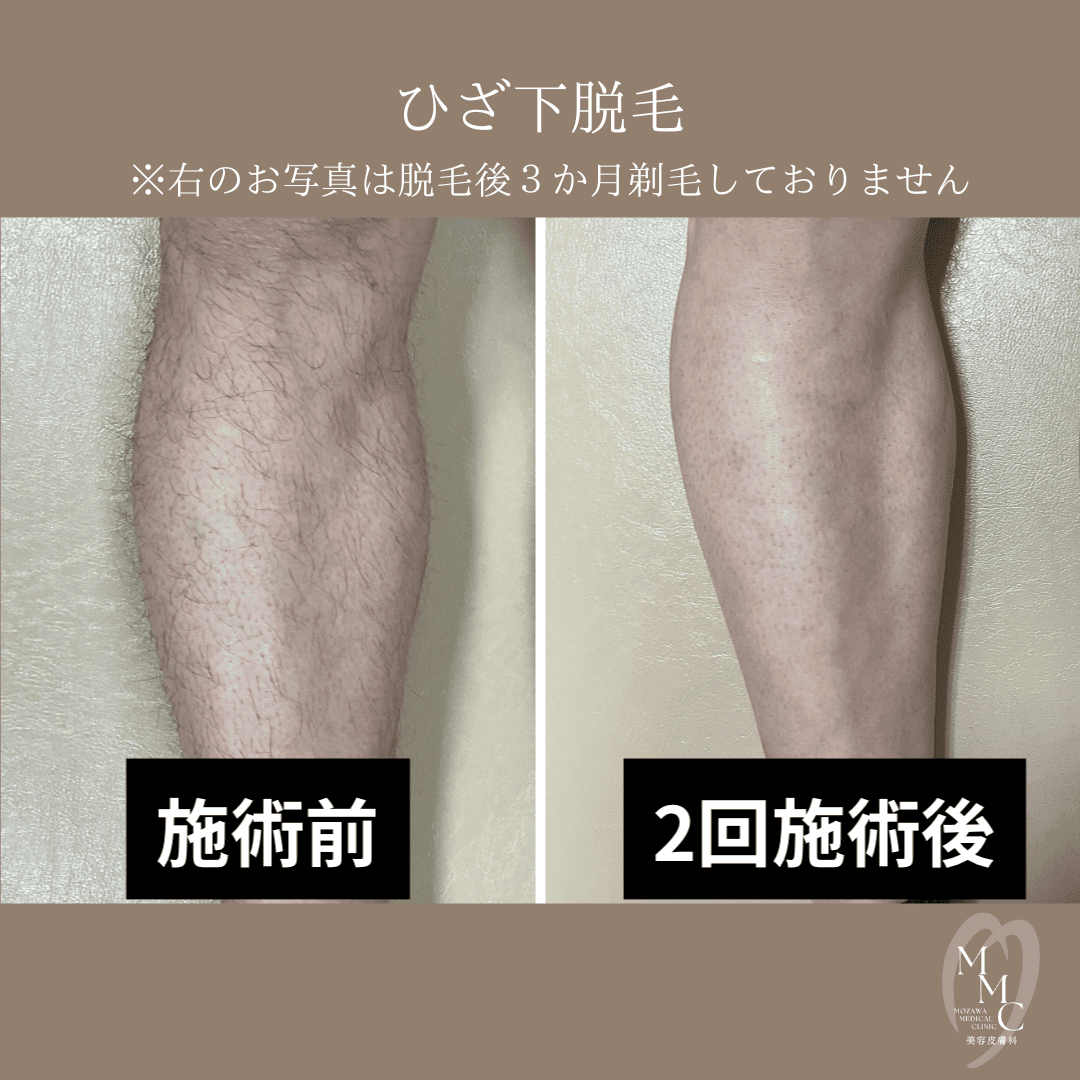 医療脱毛 | 全身脱毛やVIO脱毛なら荒川区南千住駅3分の茂澤メディカル