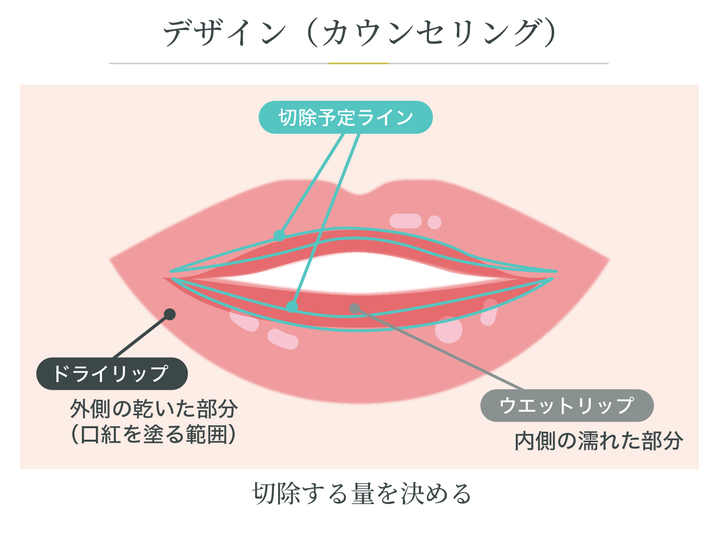 たらこ唇修正・口唇縮小術 - 銀座マイアミ美容外科