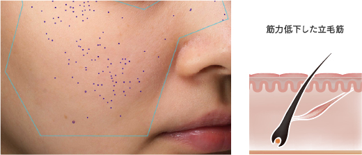 MYTREX PROVE | トータルリフト美顔器 -