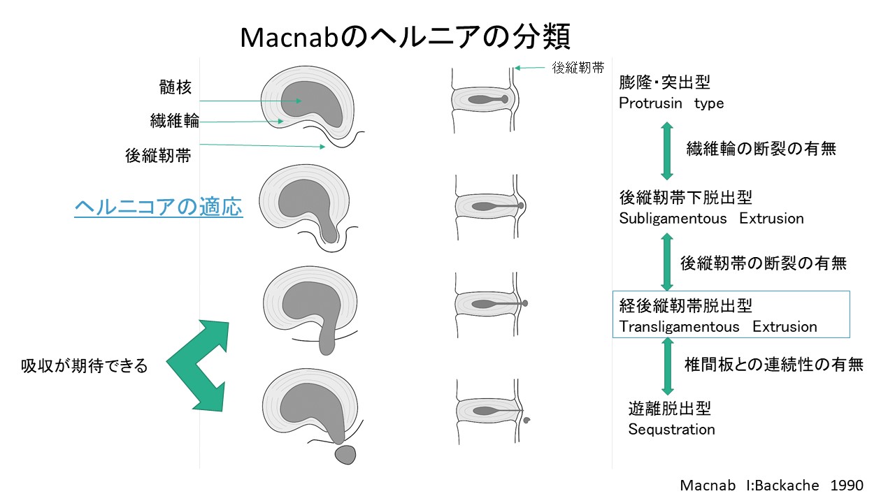 腰椎椎間板ヘルニアは自然に治る？自然退縮の最新研究と予測因子を徹底