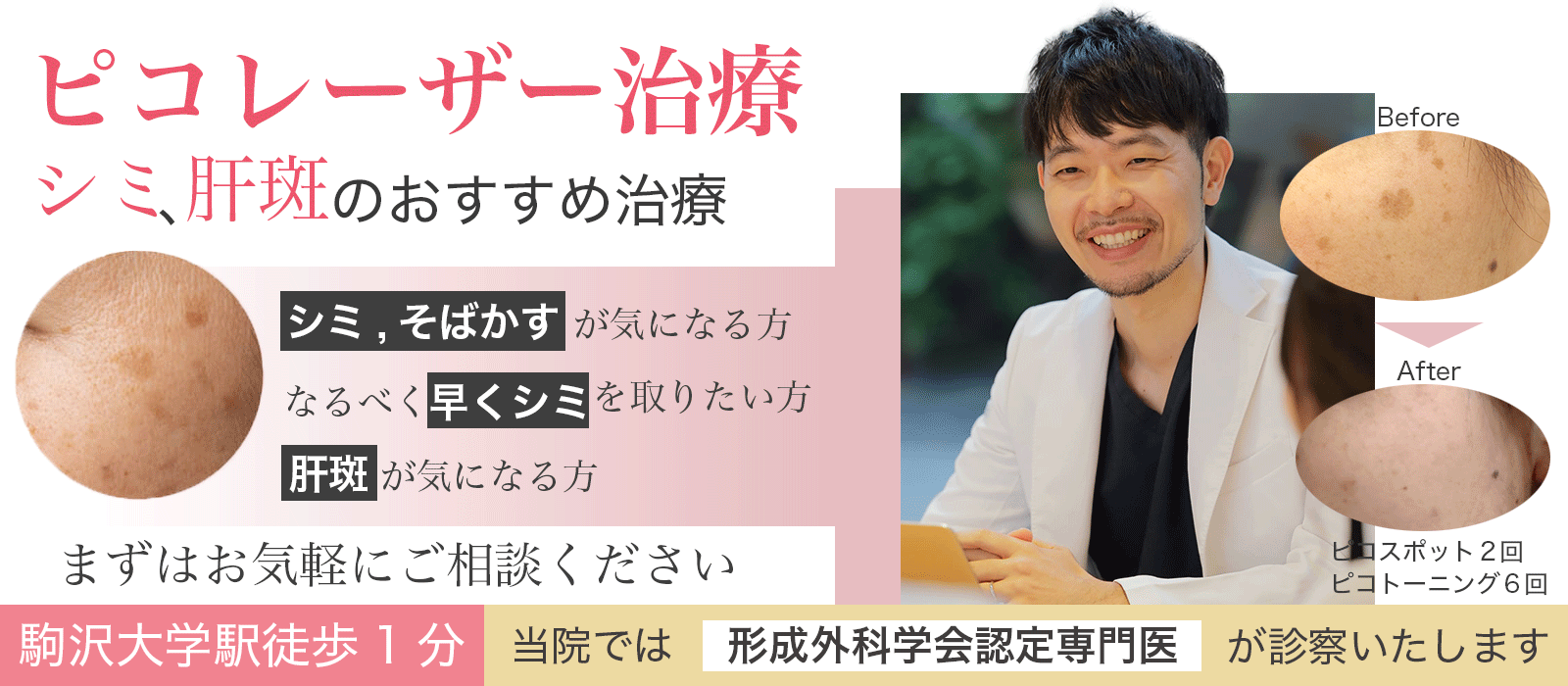 ピコレーザーでシミ取り治療・肝斑治療｜世田谷区駒沢大学駅から徒歩1