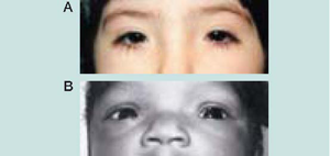 国際基準に基づく小奇形アトラス - 日本小児遺伝学会