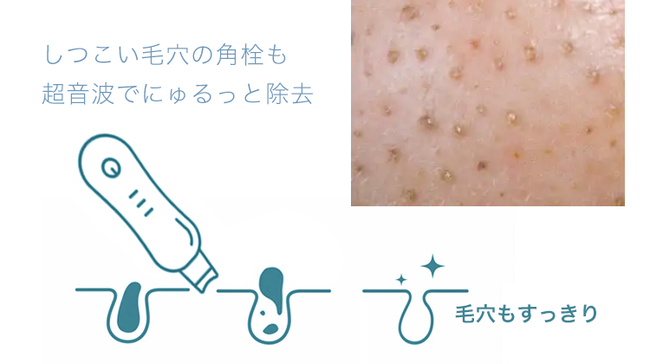 毛穴の汚れをごっそり【美顔器 ウォーターピーリング】リニューアル