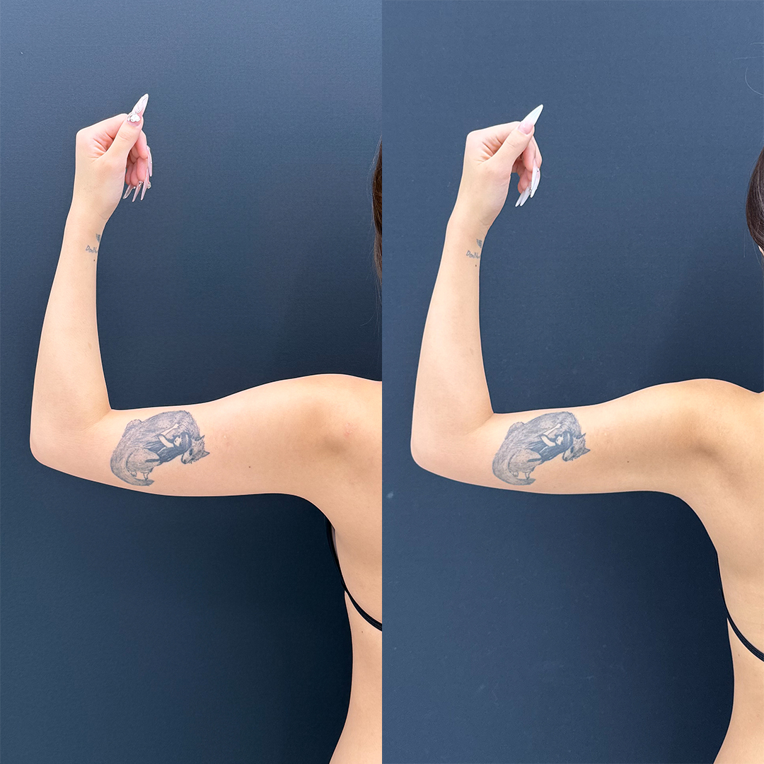 二の腕の脂肪吸引】20代前半・BMI18.2｜純脂肪500cc吸引で叶える「3D