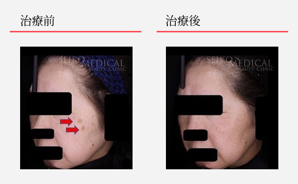 是非ミラミンだけでもお試しください | ゼオスキンヘルス｜セイコ