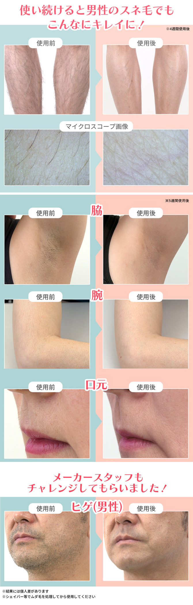 今 お得！】CQ クリニカルエピ プロフェッショナル／ムダ毛ケア／冷却