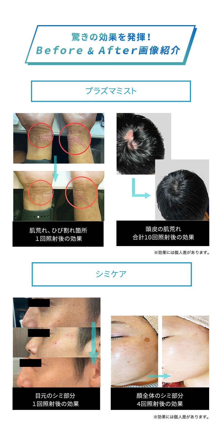 シミプラズマ｜Dr.VISEA