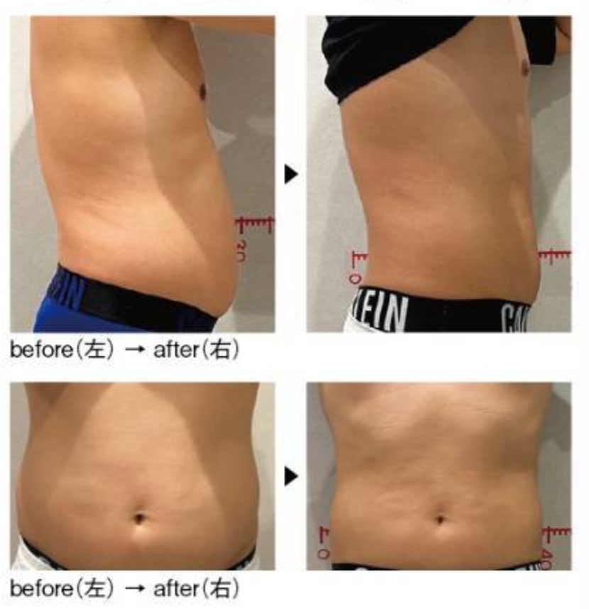 中津市】一度の施術で20%の脂肪にアプローチ!『Diar』の脂肪冷却