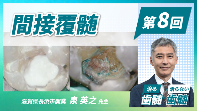 治る歯髄 治らない歯髄 - 歯髄保存の科学と臨床 - 第8回 「間接覆髄