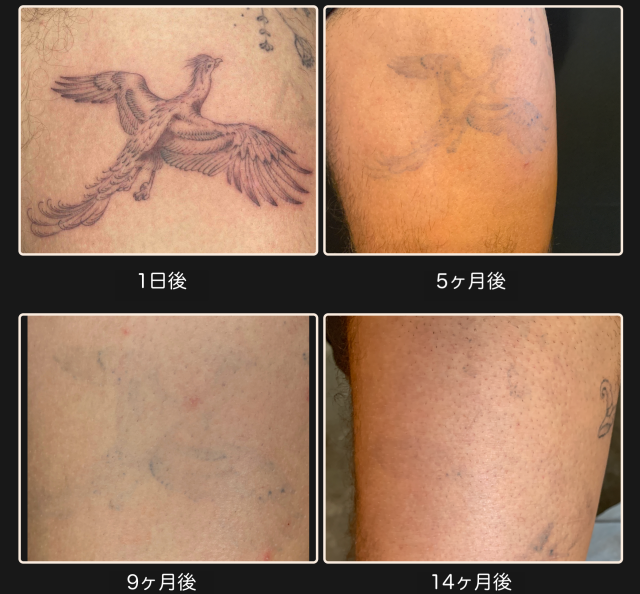 エフェメラルタトゥーとは？3年で消える本物のタトゥー |EPHEMERAL