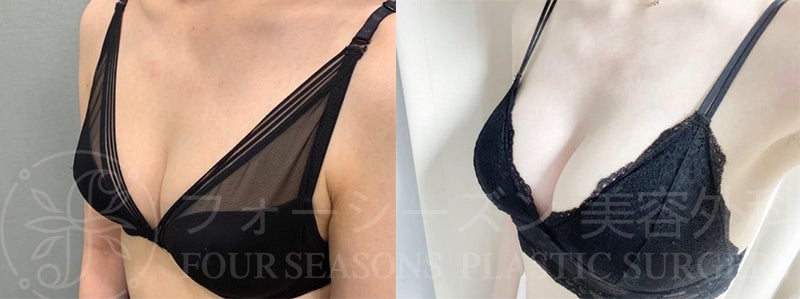 韓国整形/韓国美容外科】「大公開」ベラジェル豊胸手術♥BEFORE➔AFTER