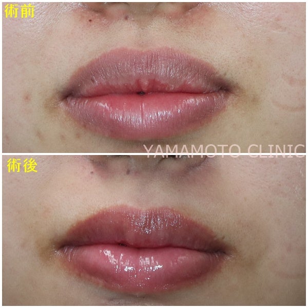 たらこ唇を薄くする方法 | やまくり女子すたっふの美的日常