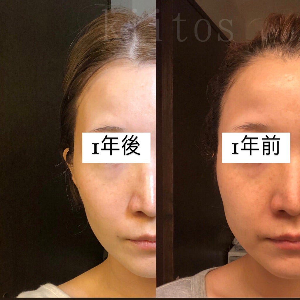 セルキュア4tplusを1年間使ったらこんなに変わった！ | 口コミ